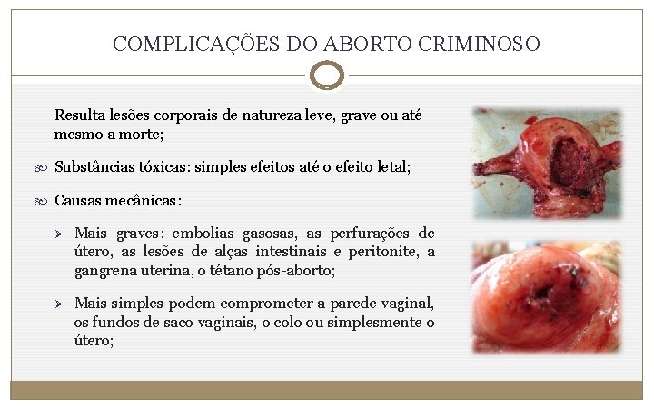 COMPLICAÇÕES DO ABORTO CRIMINOSO Resulta lesões corporais de natureza leve, grave ou até mesmo