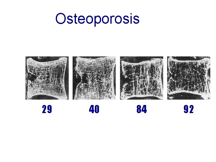 Osteoporosis 29 40 84 92 