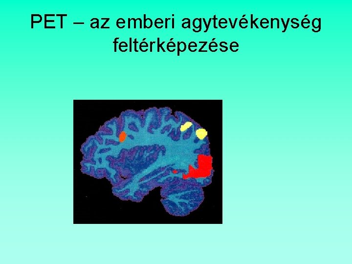 PET – az emberi agytevékenység feltérképezése 