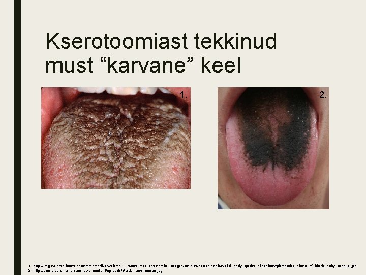 Kserotoomiast tekkinud must “karvane” keel 1. 2. 1. http: //img. webmd. boots. com/dtmcms/live/webmd_uk/consumer_assets/site_images/articles/health_tools/weird_body_quirks_slideshow/phototake_photo_of_black_hairy_tongue. jpg