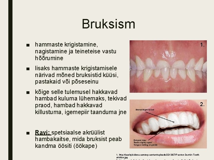 Bruksism ■ hammaste krigistamine, nagistamine ja teineteise vastu hõõrumine 1. ■ lisaks hammaste krigistamisele