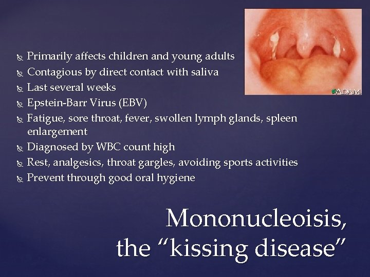  Primarily affects children and young adults Contagious by direct contact with saliva Last