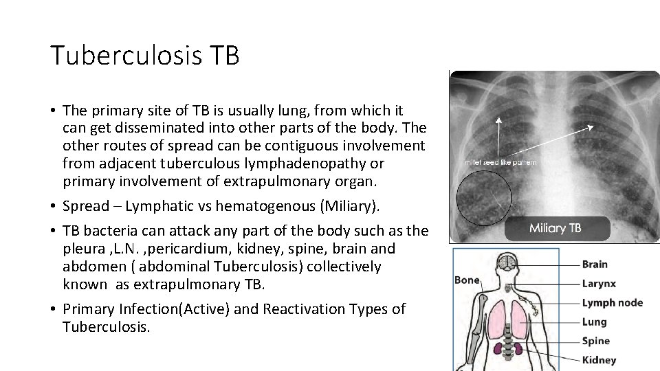 Tuberculosis TB • The primary site of TB is usually lung, from which it