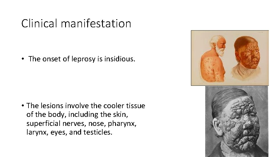 Clinical manifestation • The onset of leprosy is insidious. • The lesions involve the