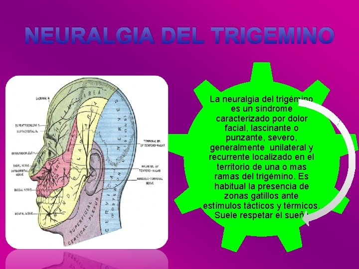 NEURALGIA DEL TRIGEMINO La neuralgia del trigémino es un síndrome caracterizado por dolor facial,