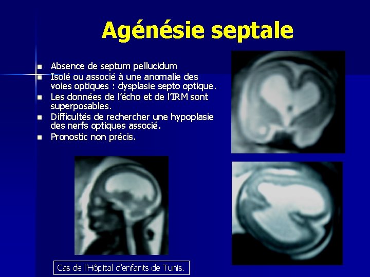 Agénésie septale n n n Absence de septum pellucidum Isolé ou associé à une