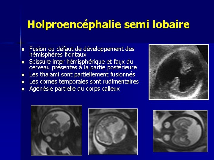 Holproencéphalie semi lobaire n n n Fusion ou défaut de développement des hémisphères frontaux