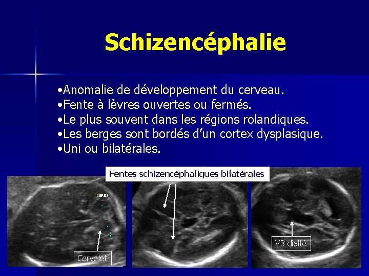 Schizencéphalie • Anomalie de développement du cerveau. • Fente à lèvres ouvertes ou fermés.