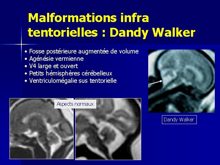 Malformations infra tentorielles : Dandy Walker • Fosse postérieure augmentée de volume • Agénésie