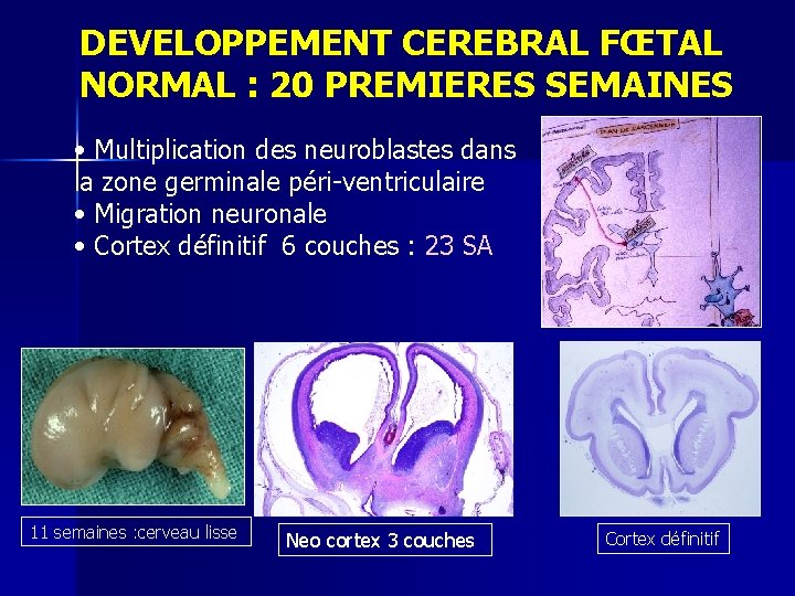 DEVELOPPEMENT CEREBRAL FŒTAL NORMAL : 20 PREMIERES SEMAINES • Multiplication des neuroblastes dans la
