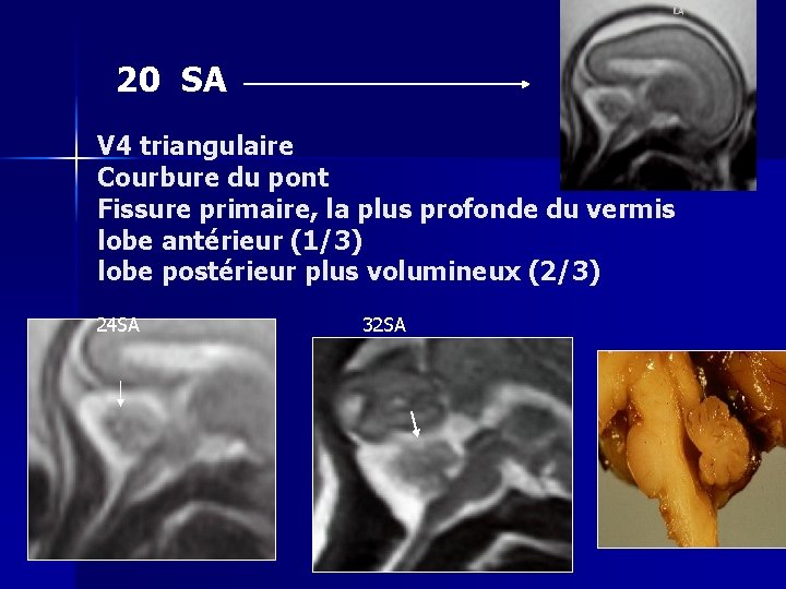 20 SA V 4 triangulaire Courbure du pont Fissure primaire, la plus profonde du