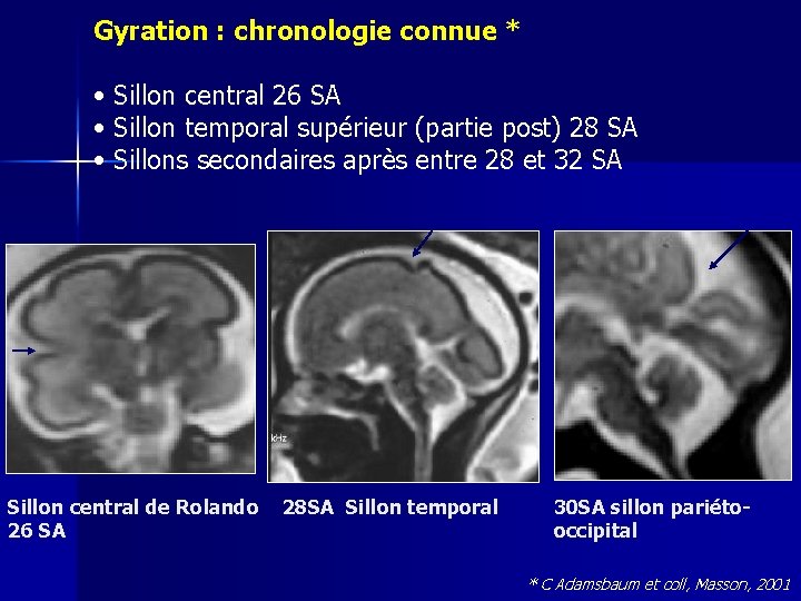 Gyration : chronologie connue * • Sillon central 26 SA • Sillon temporal supérieur