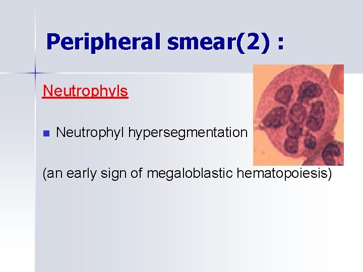 Peripheral smear(2) : Neutrophyls n Neutrophyl hypersegmentation (an early sign of megaloblastic hematopoiesis) 