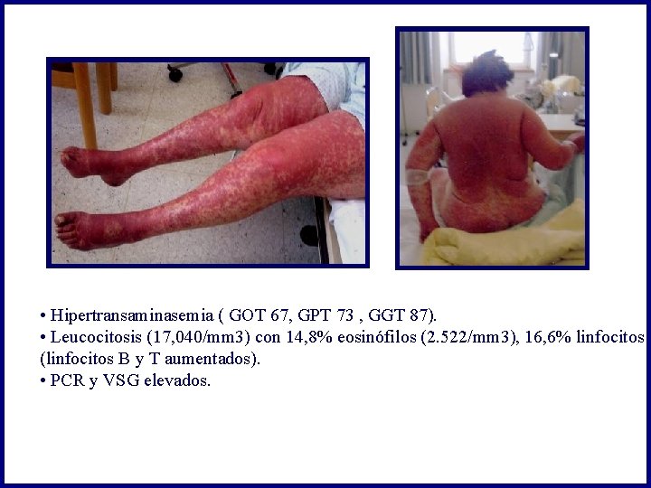  • Hipertransaminasemia ( GOT 67, GPT 73 , GGT 87). • Leucocitosis (17,