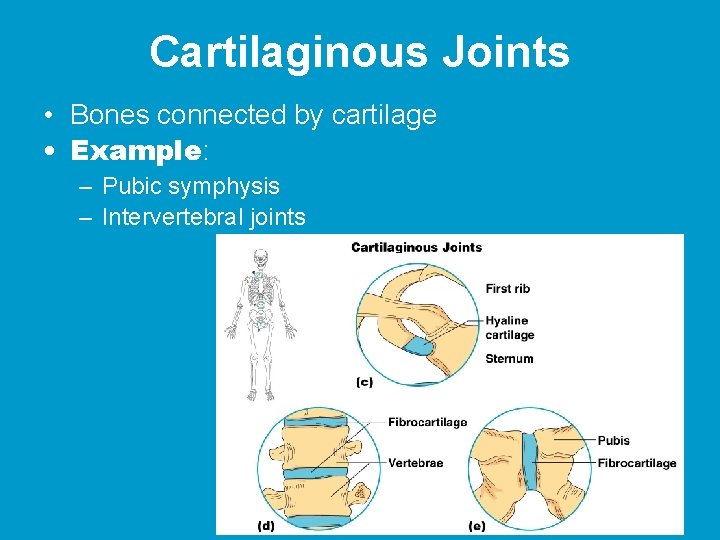 Cartilaginous Joints • Bones connected by cartilage • Example: – Pubic symphysis – Intervertebral