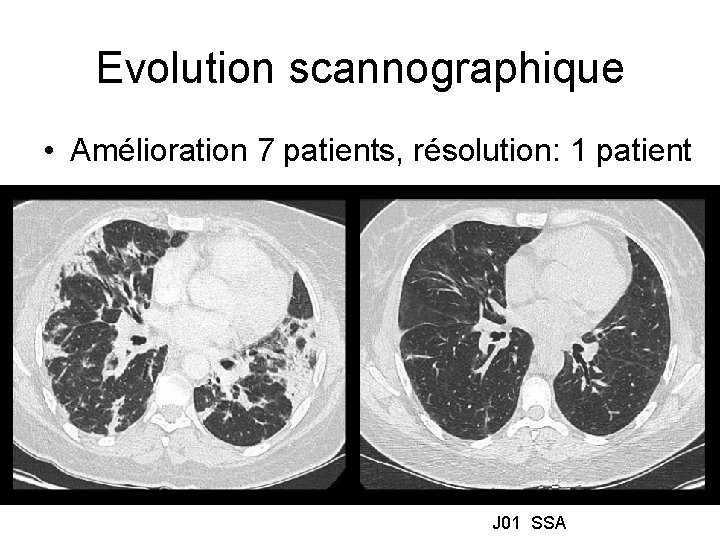 Evolution scannographique • Amélioration 7 patients, résolution: 1 patient J 01 SSA 