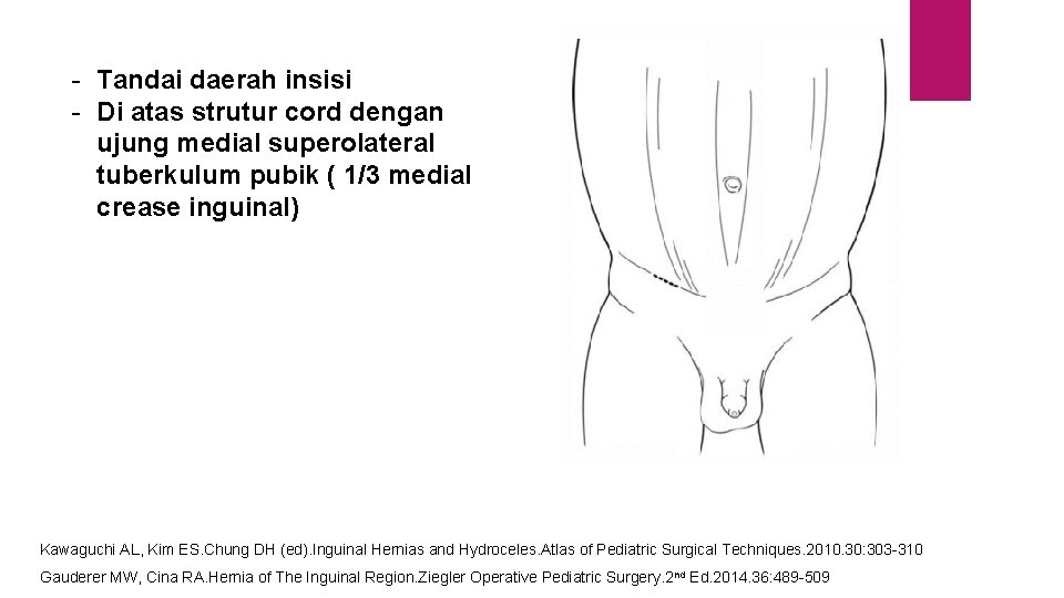 - Tandai daerah insisi - Di atas strutur cord dengan ujung medial superolateral tuberkulum