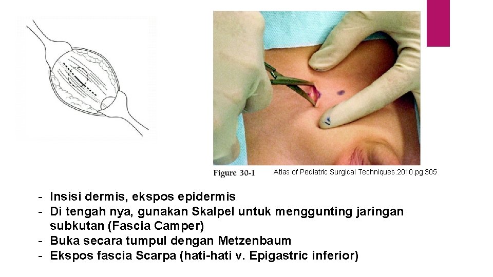 Atlas of Pediatric Surgical Techniques. 2010. pg 305 - Insisi dermis, ekspos epidermis -