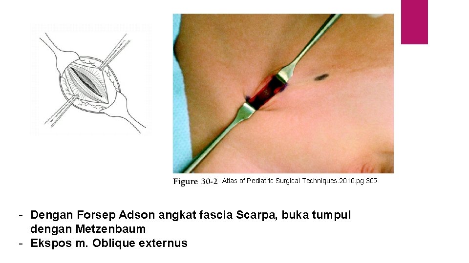 Atlas of Pediatric Surgical Techniques. 2010. pg 305 - Dengan Forsep Adson angkat fascia