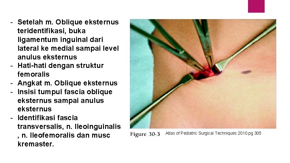 - Setelah m. Oblique eksternus teridentifikasi, buka ligamentum inguinal dari lateral ke medial sampai
