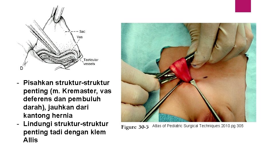 - Pisahkan struktur-struktur penting (m. Kremaster, vas deferens dan pembuluh darah), jauhkan dari kantong