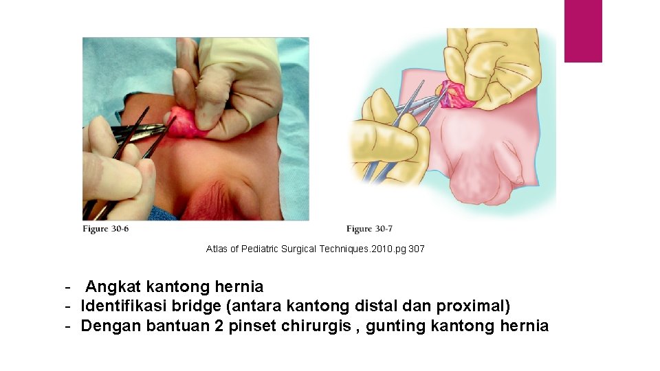 Atlas of Pediatric Surgical Techniques. 2010. pg 307 - Angkat kantong hernia - Identifikasi