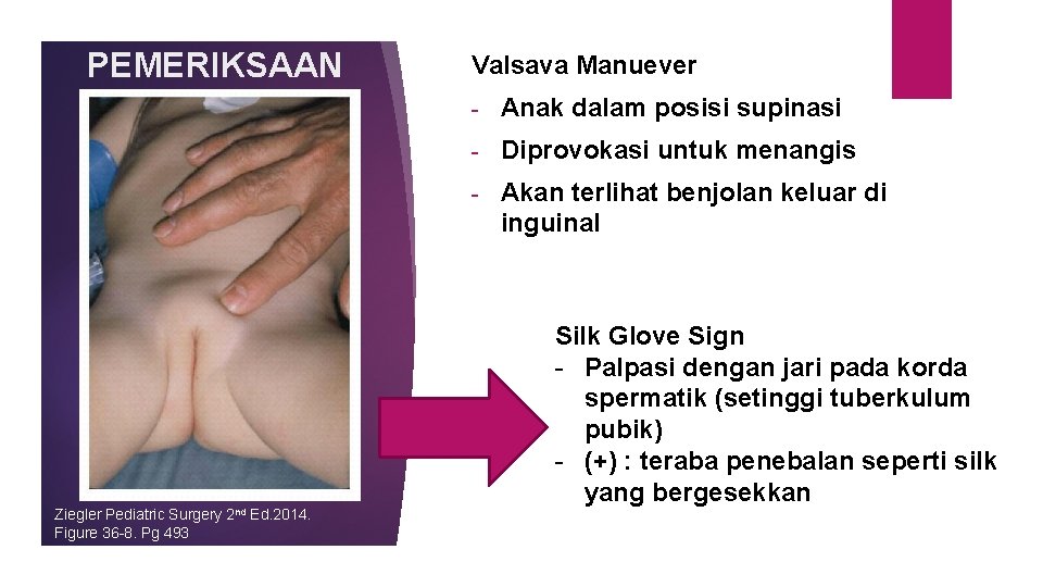 PEMERIKSAAN Ziegler Pediatric Surgery 2 nd Ed. 2014. Figure 36 -8. Pg 493 Valsava