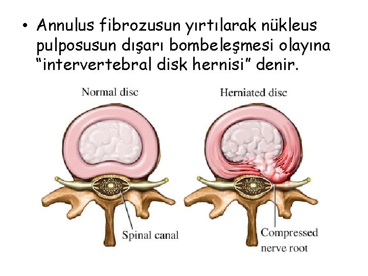  • Annulus fibrozusun yırtılarak nükleus pulposusun dışarı bombeleşmesi olayına “intervertebral disk hernisi” denir.