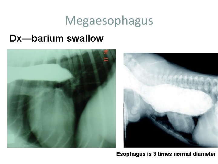 Megaesophagus Dx—barium swallow Esophagus is 3 times normal diameter 