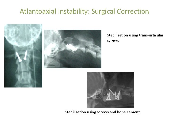 Atlantoaxial Instability: Surgical Correction Stabilization using trans-articular screws Stabilization using screws and bone cement