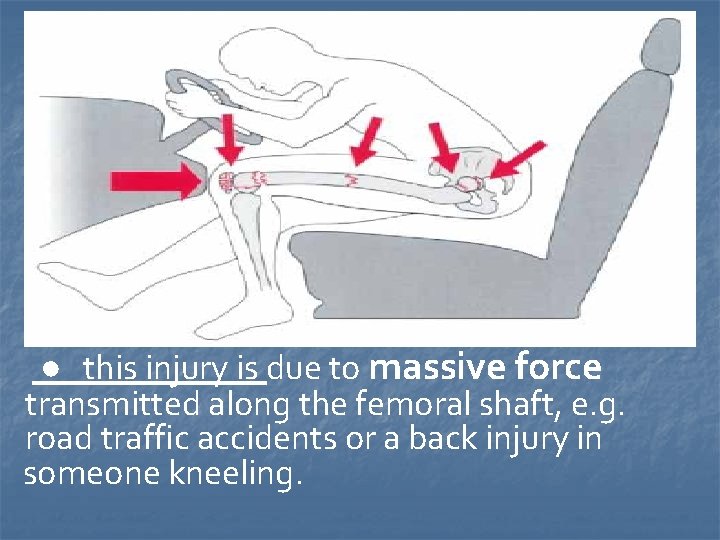 ● this injury is due to massive force transmitted along the femoral shaft, e.