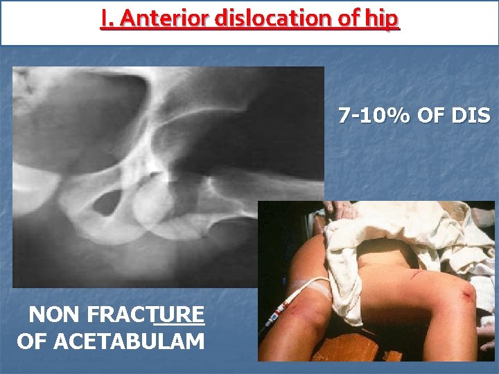 I. Anterior dislocation of hip 7 -10% OF DIS NON FRACTURE OF ACETABULAM 