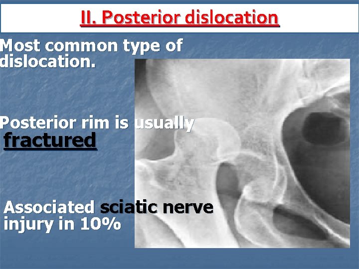 II. Posterior dislocation Most common type of dislocation. Posterior rim is usually fractured Associated
