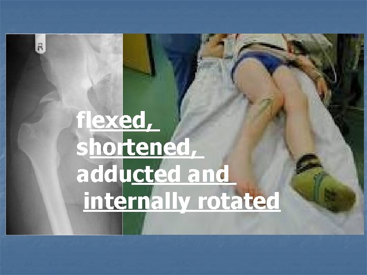 flexed, shortened, adducted and internally rotated 