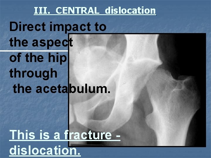 III. CENTRAL dislocation Direct impact to the aspect of the hip through the acetabulum.