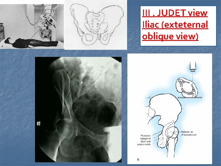 III. JUDET view Iliac (exteternal oblique view) 