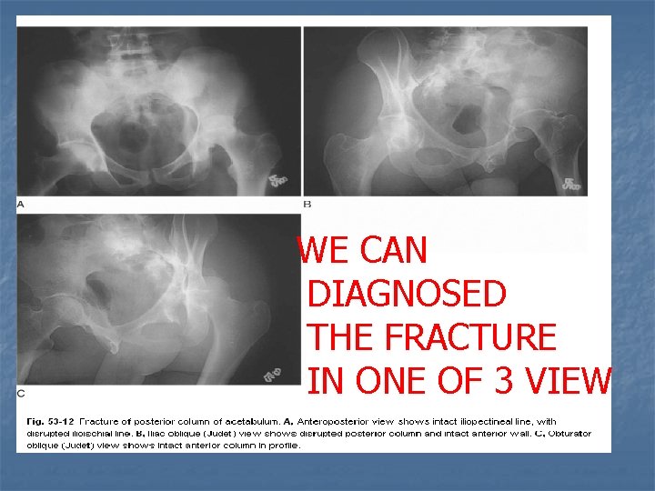 WE CAN DIAGNOSED THE FRACTURE IN ONE OF 3 VIEW 