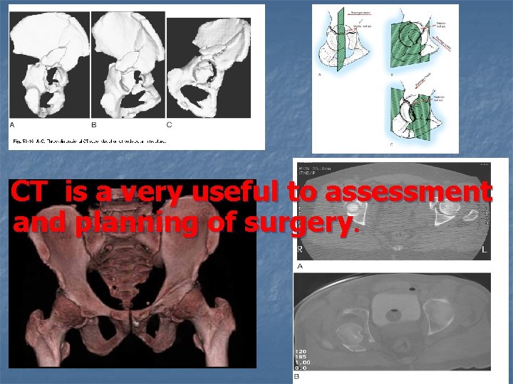 CT is a very useful to assessment and planning of surgery. 