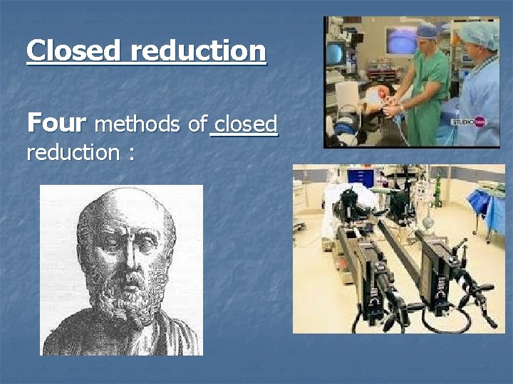 Closed reduction Four methods of closed reduction : 