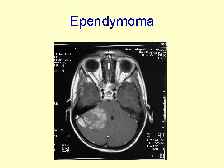 Ependymoma 