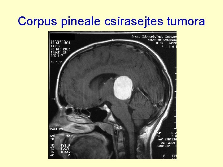 Corpus pineale csírasejtes tumora 