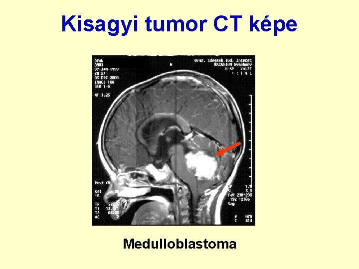 Kisagyi tumor CT képe Medulloblastoma 