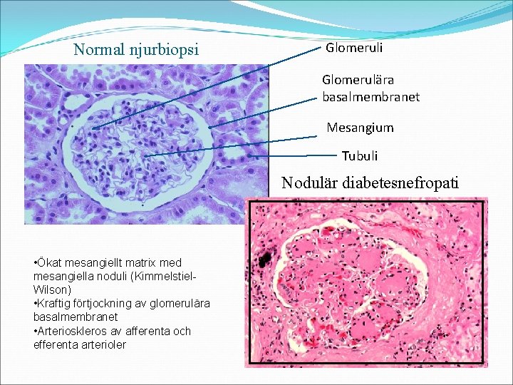 Normal njurbiopsi Glomerulära basalmembranet Mesangium Tubuli Nodulär diabetesnefropati • Ökat mesangiellt matrix med mesangiella