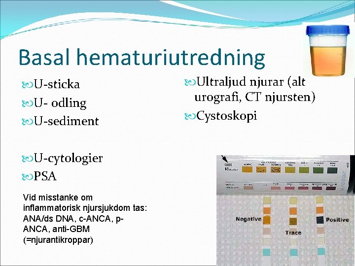 Basal hematuriutredning U-sticka U- odling U-sediment U-cytologier PSA Vid misstanke om inflammatorisk njursjukdom tas: