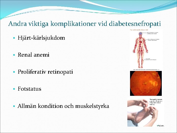 Andra viktiga komplikationer vid diabetesnefropati • Hjärt-kärlsjukdom • Renal anemi • Proliferativ retinopati •