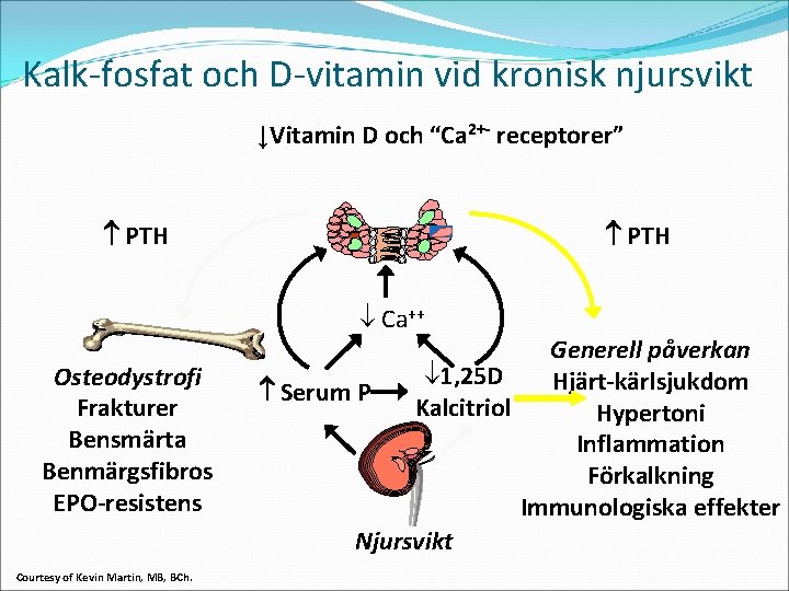 Kalk-fosfat och D-vitamin vid kronisk njursvikt ↓Vitamin D och “Ca 2+- receptorer” PTH Ca++