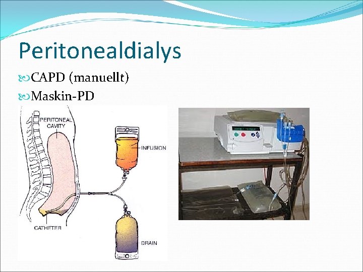 Peritonealdialys CAPD (manuellt) Maskin-PD 