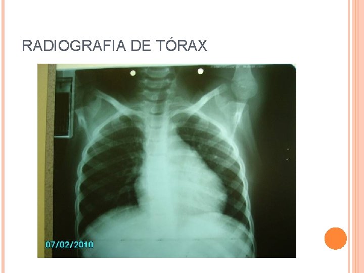 RADIOGRAFIA DE TÓRAX 