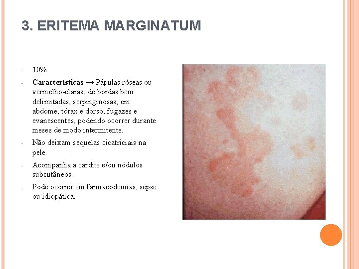 3. ERITEMA MARGINATUM - 10% - Características → Pápulas róseas ou vermelho-claras, de bordas