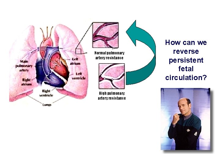 Normal pulmonary artery resistance High pulmonary artery resistance How can we reverse persistent fetal